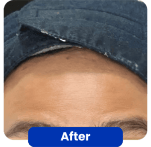 before-after botox wajah