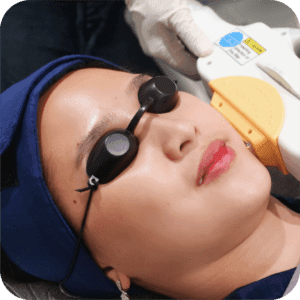 ipl treatment - ipl glow - perawatan wajah