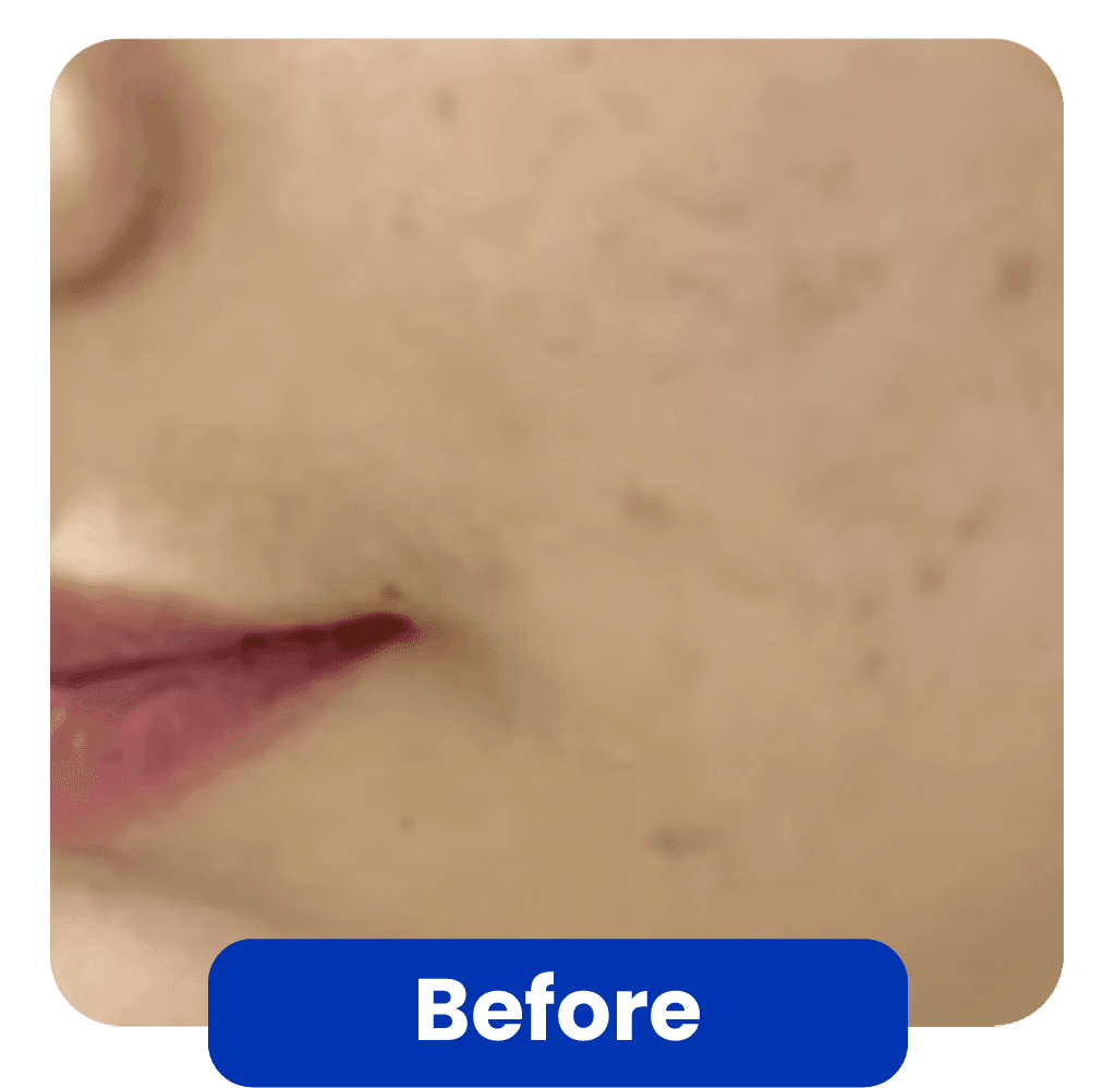 Kondisi Kulit Sebelum Skin Booster Treatment