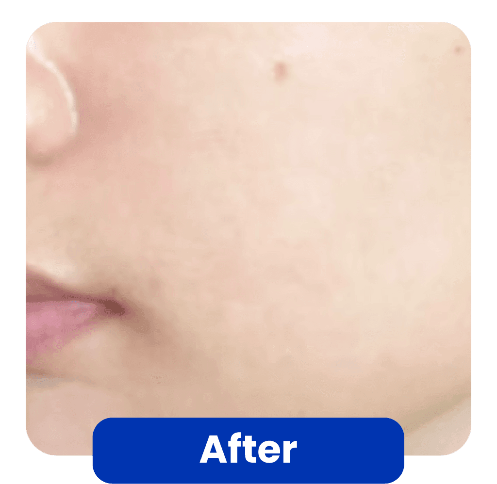 Kondisi Kulit Setelah Skin Booster Treatment