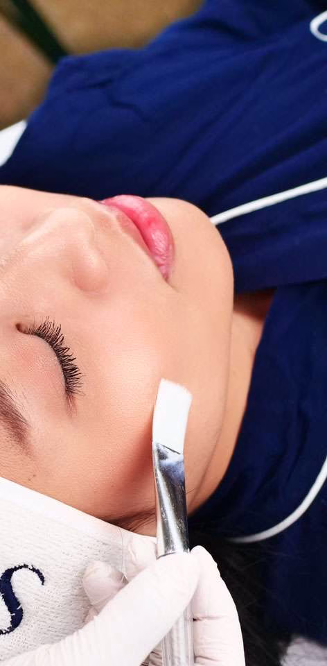 acne peel - sozo skin clinic - derma peel treatment