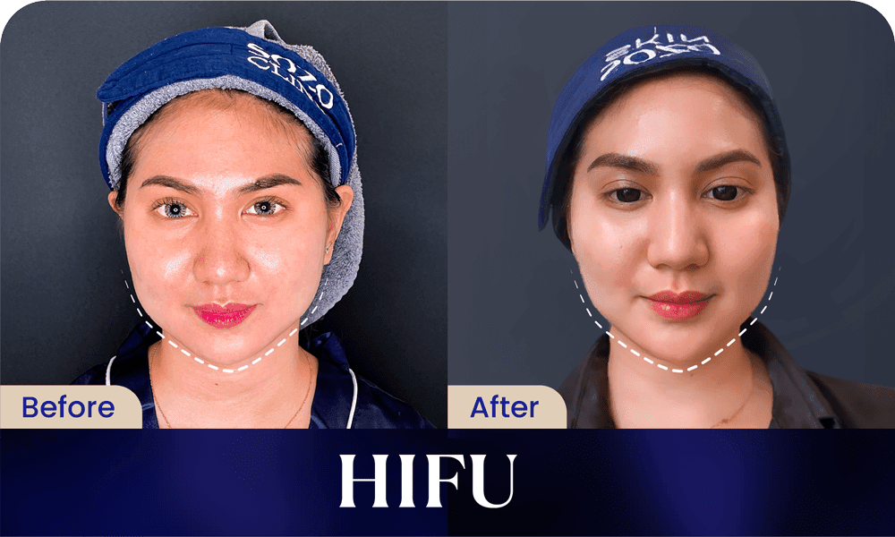 Before After HIFU Treatment 2