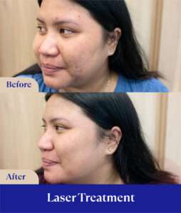 before after treatment laser sozo skin clinic