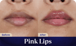 before after pink lips treatment - klinik kecantikan sozo skin clinic