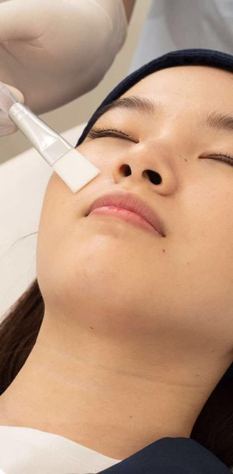 glow peel - sozo skin clinic - derma peel treatment