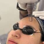 nano laser - sozo skin clinic