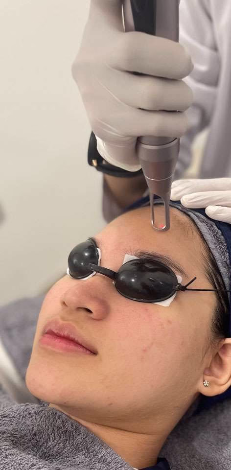 nano laser - sozo skin clinic