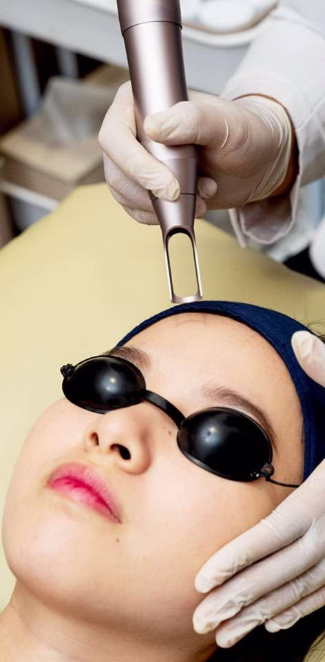 pico laser - sozo skin clinic