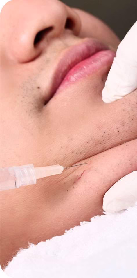 meso slimming - face - sozo skin clinic