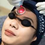 laser co2 treatment - sozo skin clinic