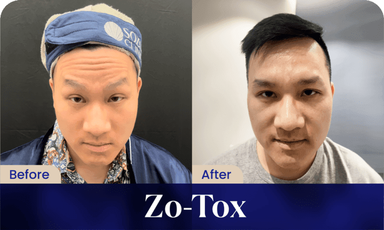 before after - sozo toxin treatment