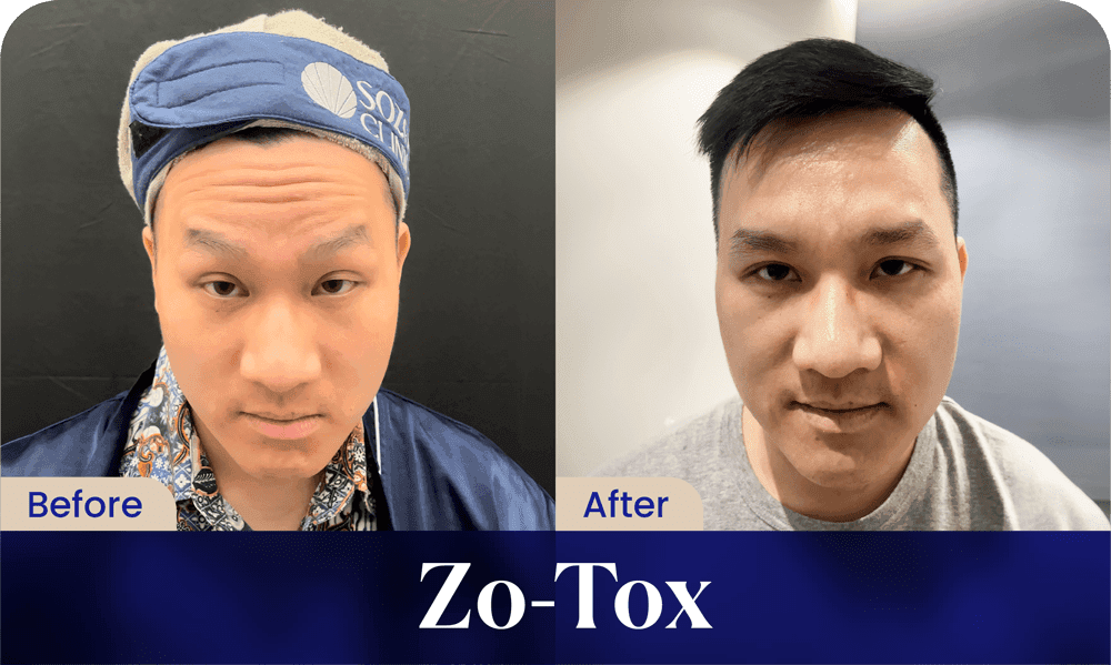 Before After Zo-Tox Treatment Sozo Skin Clinic