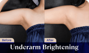 before after - laser hair removal