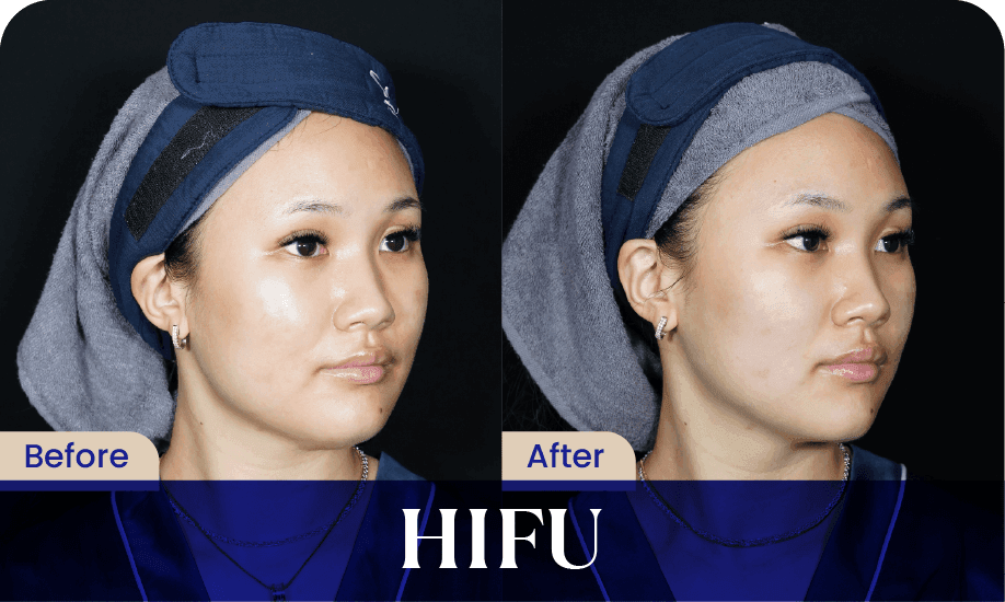 Before After HIFU Treatment 1