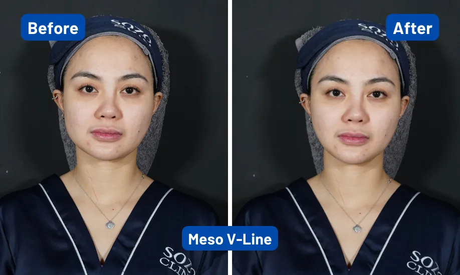 Before After Meso Slimming 1