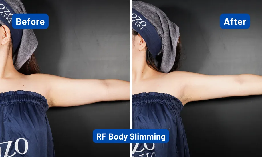 RF-BodySlimming-Before-After