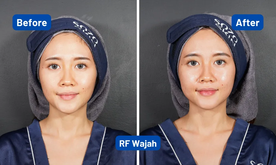 Before After Radiofrequency 1