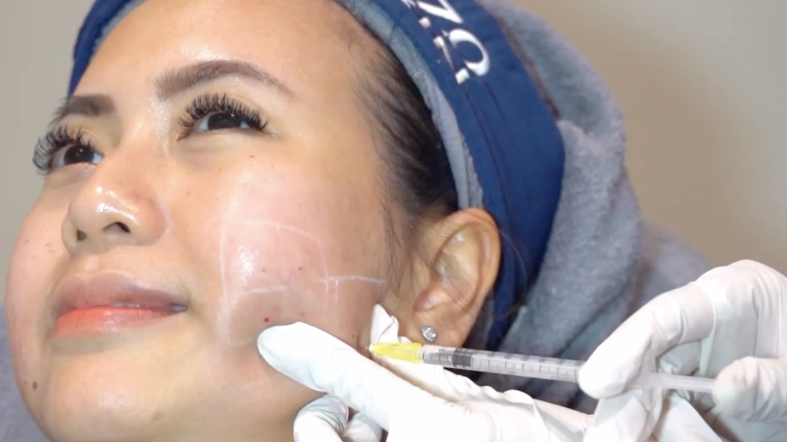 Meso-Vline-Treatment