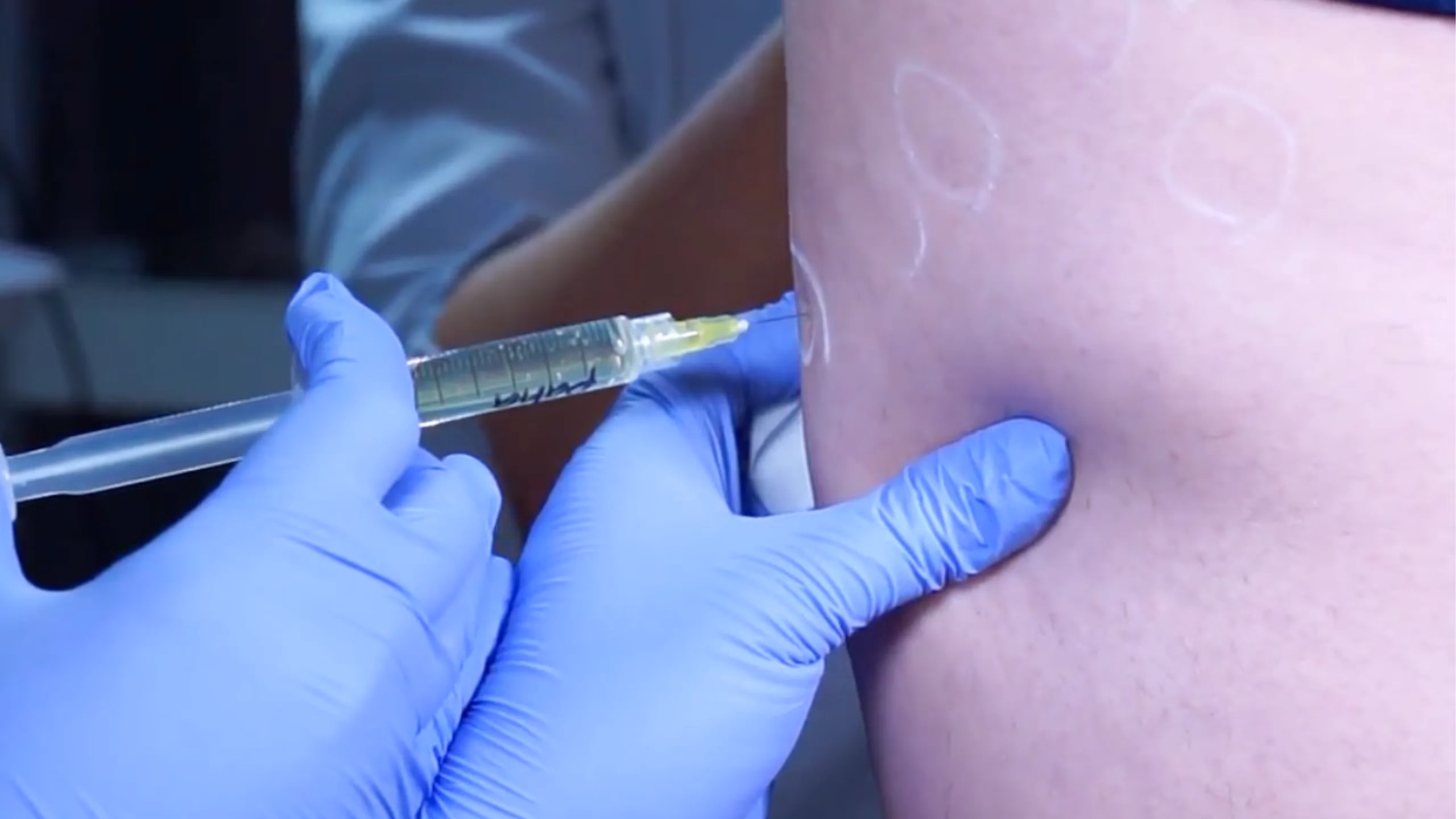 meso-celullet-treatment