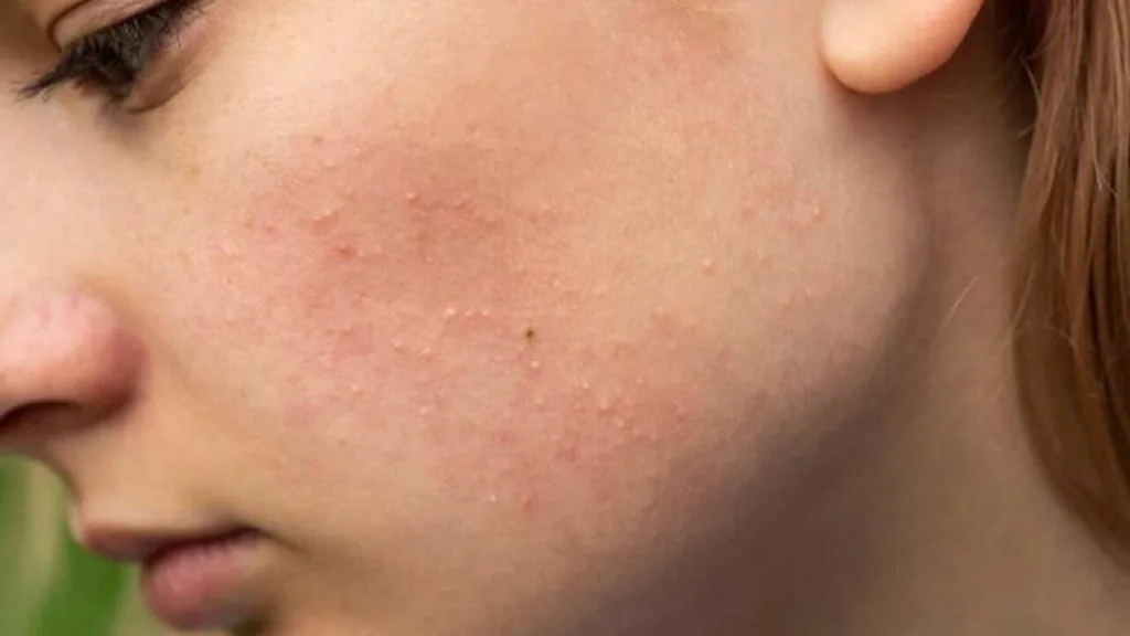 cara menghilangkan bruntusan di wajah secara alami