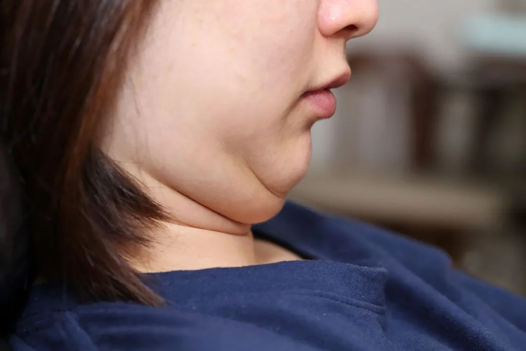 menghilangkan double chin