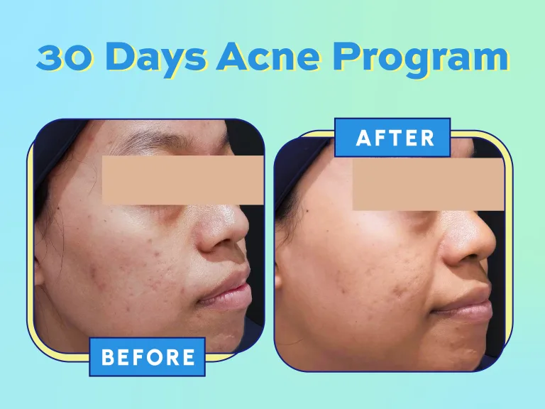 Website Acne Campaign_USP - Before-After Acne (30 Days Acne Program)