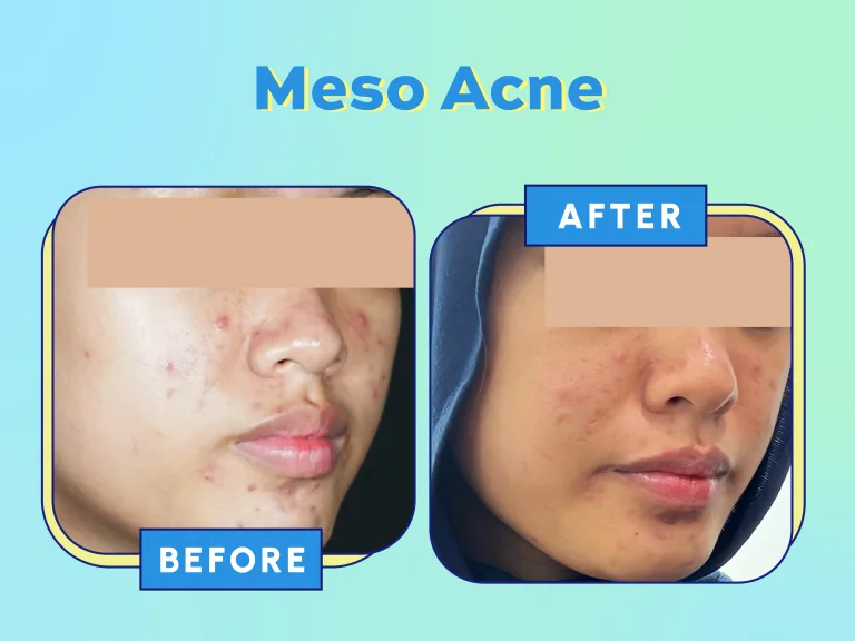 Website Acne Campaign_USP - Before-After Acne (Meso Acne)