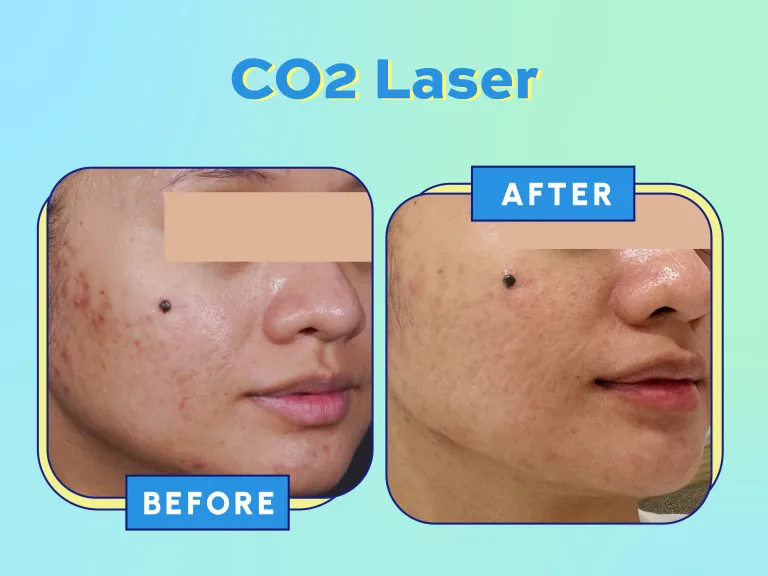 Website Acne Campaign_USP - Before-After Scar (CO2 Laser)