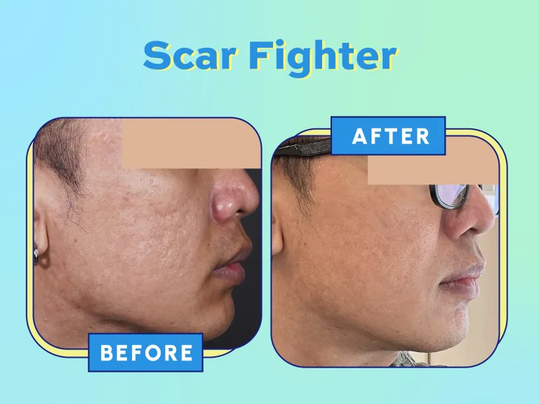 Website Acne Campaign_USP - Before-After Scar (Scar Fighter)