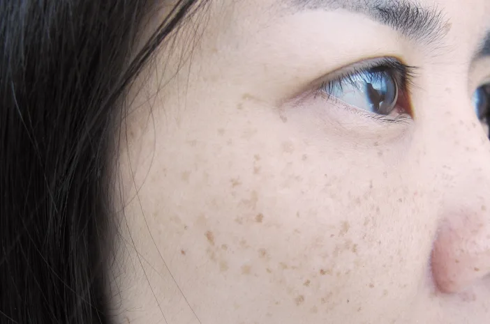 Ciri-ciri noda hitam di wajah