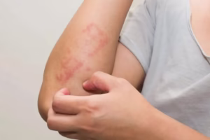 Jamur Kulit Bikin Nggak Pede? Ini Cara Tepat Mengatasinya!