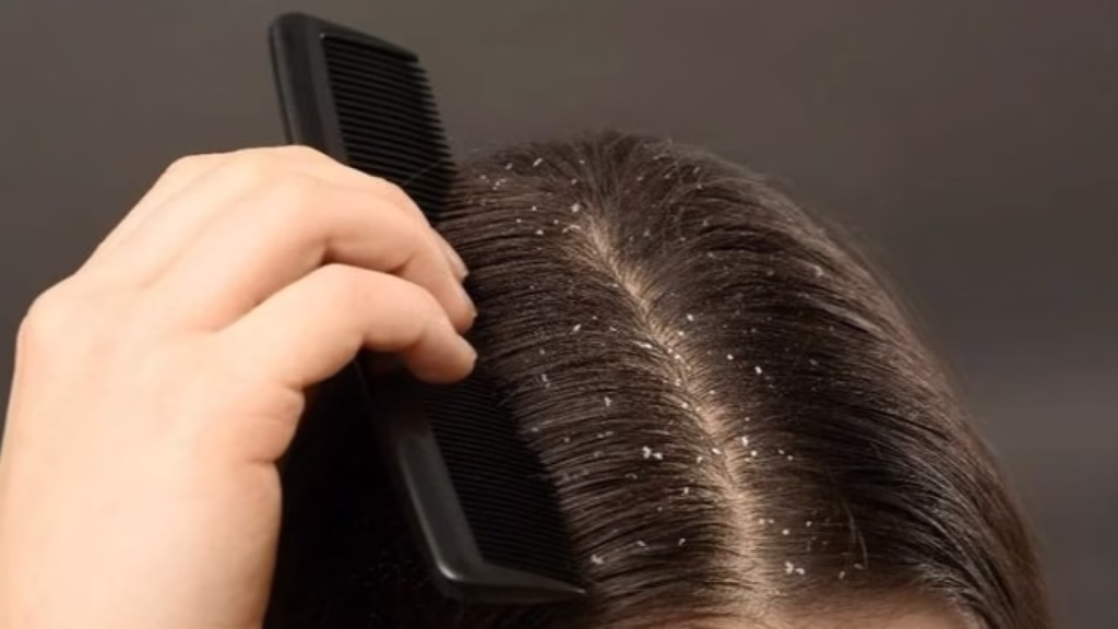 Stop Lakukan Ini! 5 Kesalahan yang Membuat Ketombe Makin Parah