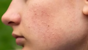 Apa Itu Fungal Acne dan Bagaimana Cara Tepat Mengatasinya? 