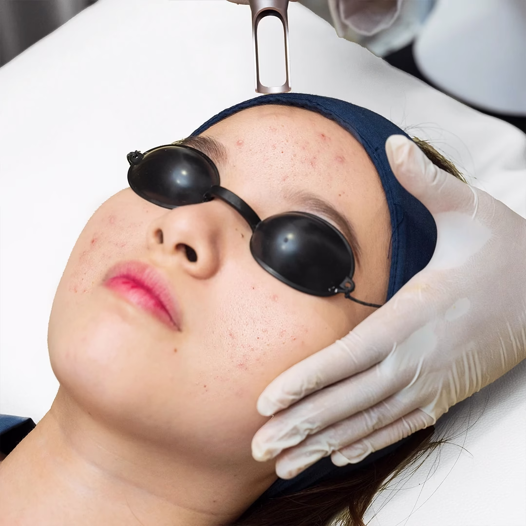Acne laser facial