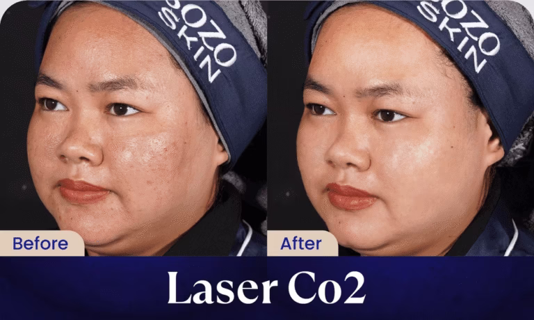 hasil-laser-co2-sozo