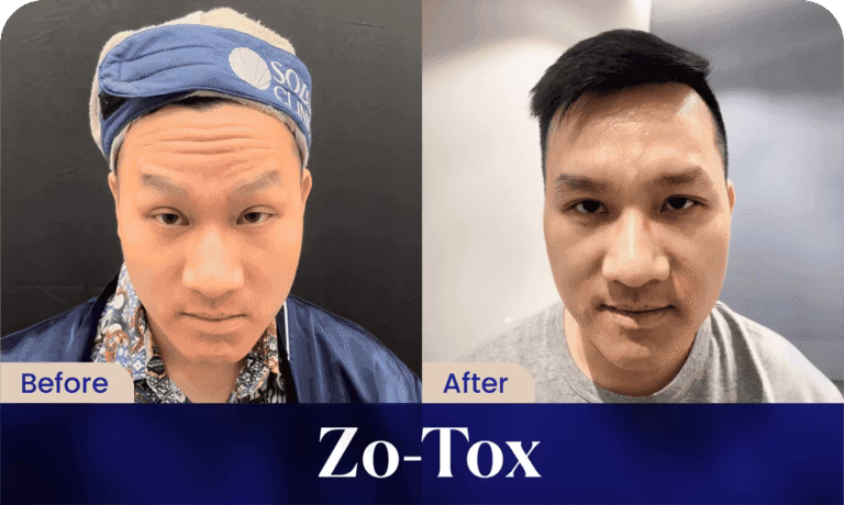 hasil-zotox-sozo