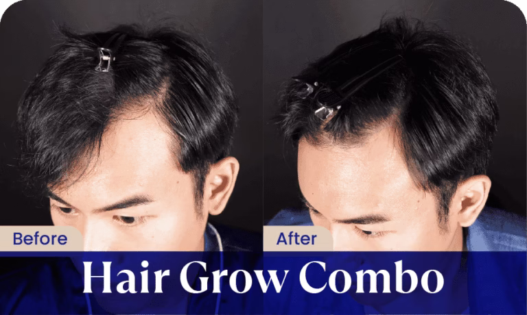 hasil-hair-grow-treatment-sozo