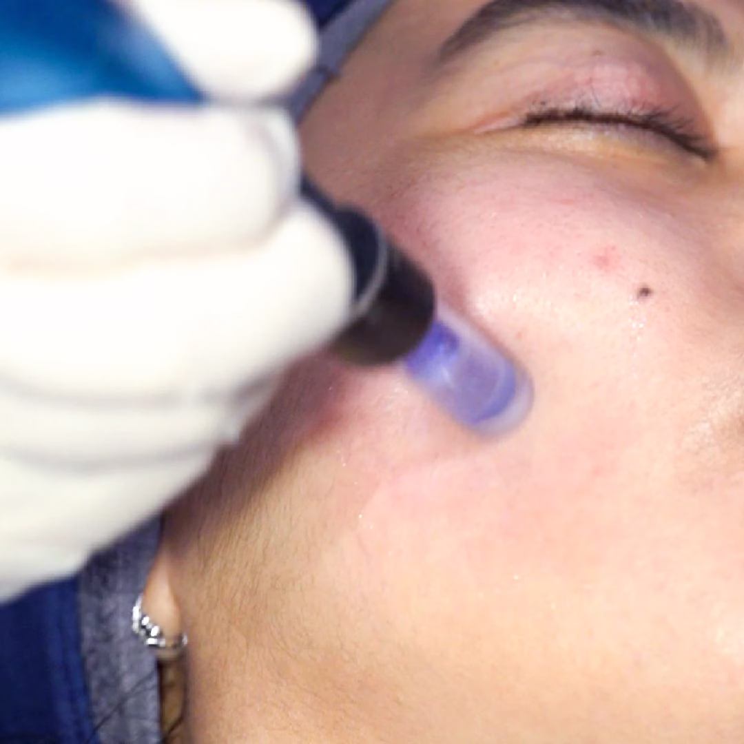 Glow Reset Laser Facial - Rejuran Shine