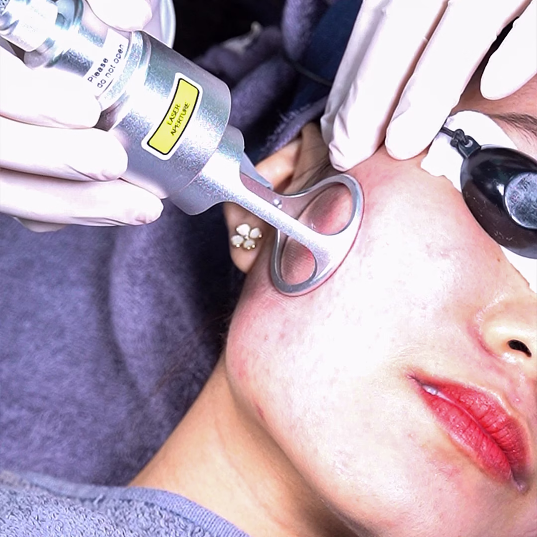 Laser CO2 - Acne scar _ Pores (Per Area)