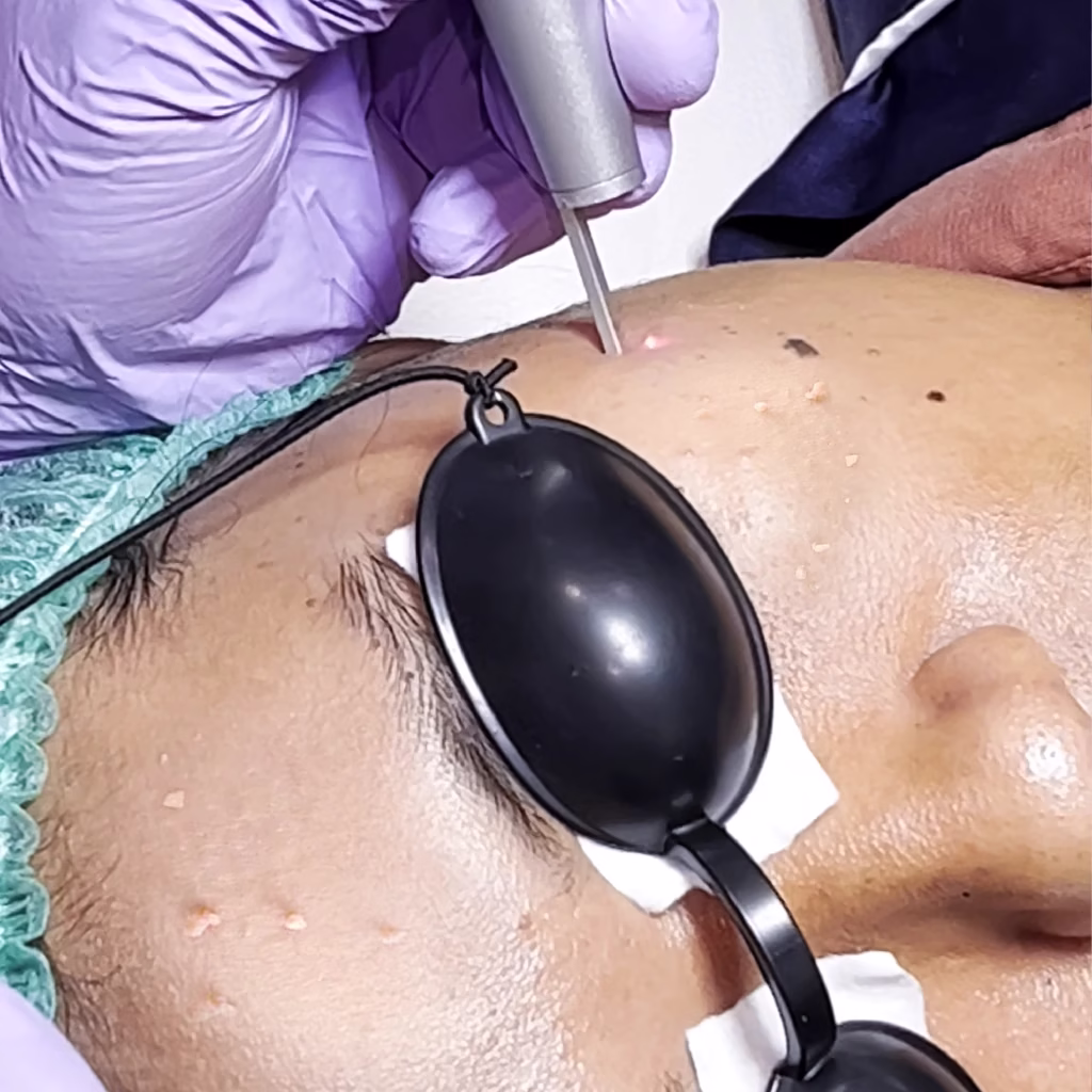 Laser CO2 - Skin Tag (Full Face)~1