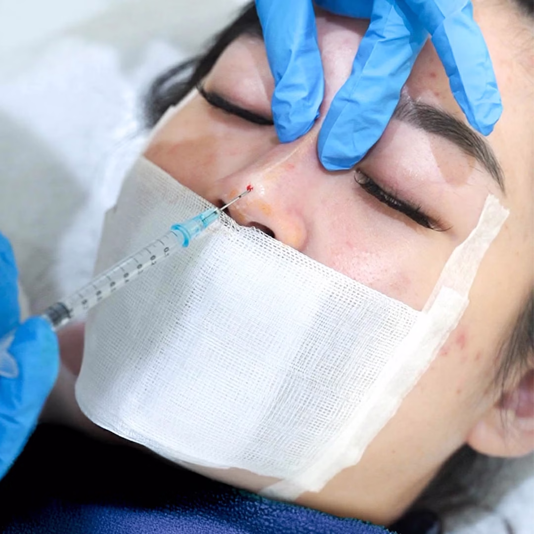 Nose Job Treatment Sozo Skin Clinic