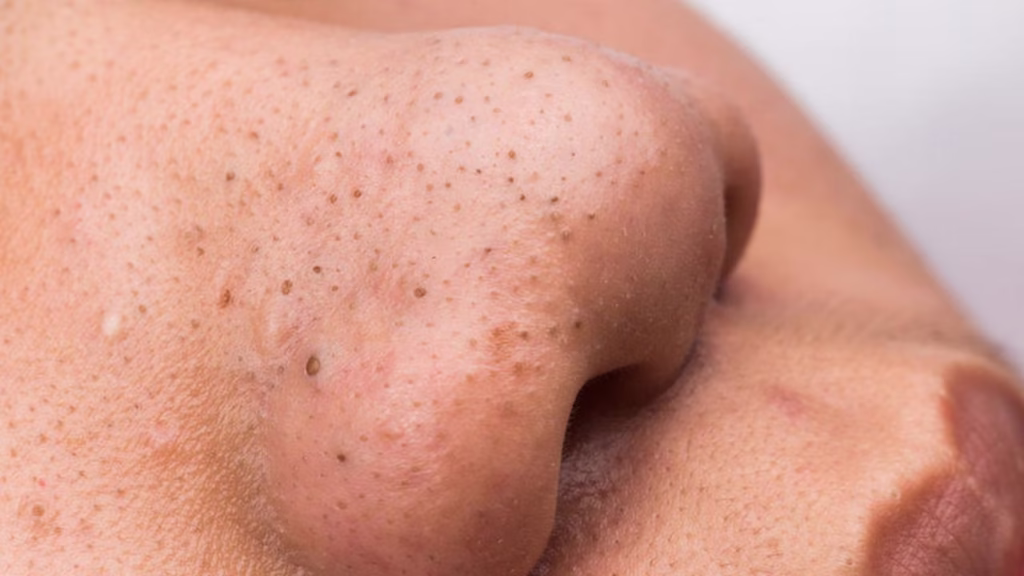 Stop Pencet! Ini Cara Menghilangkan Komedo dari Akar Penyebabnya