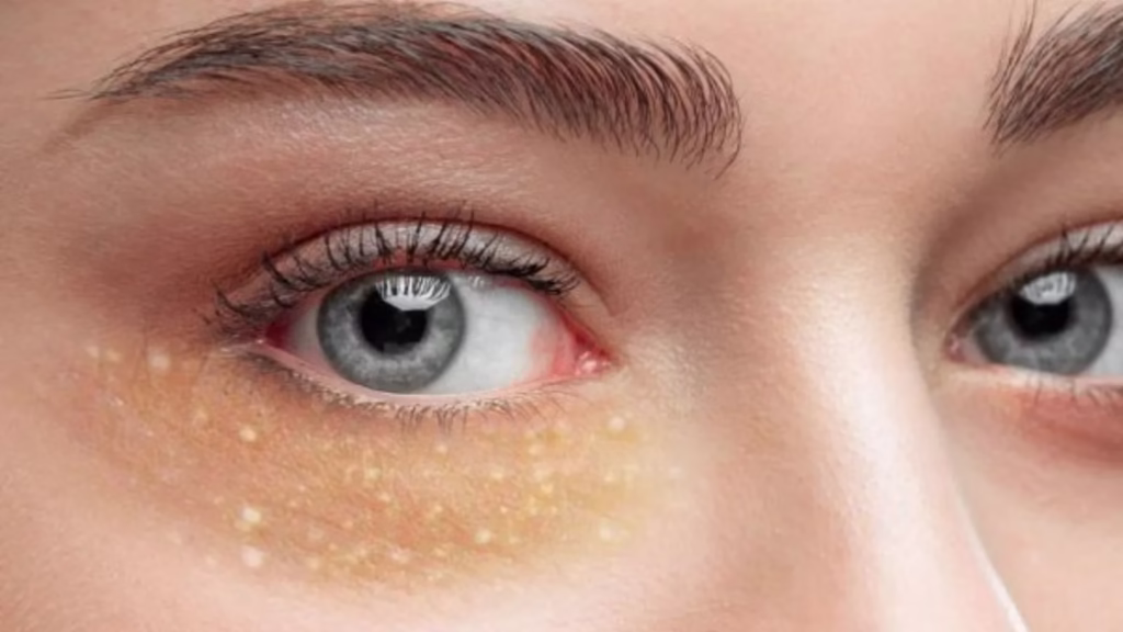 Perawatan Milia Aman di Jakarta: Solusi Cepat Hilangkan Benjolan Putih di Wajah