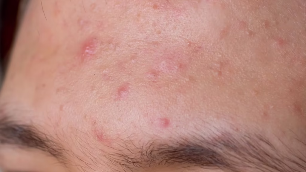 Mengatasi Biang Keringat di Wajah? Ini Panduan Lengkapnya!