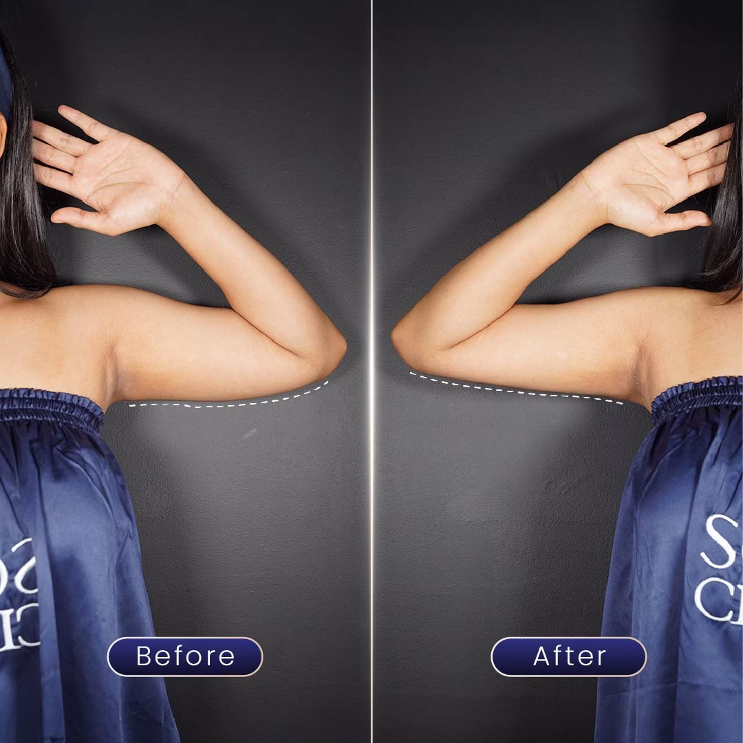 before & after lengan setelah program slimming