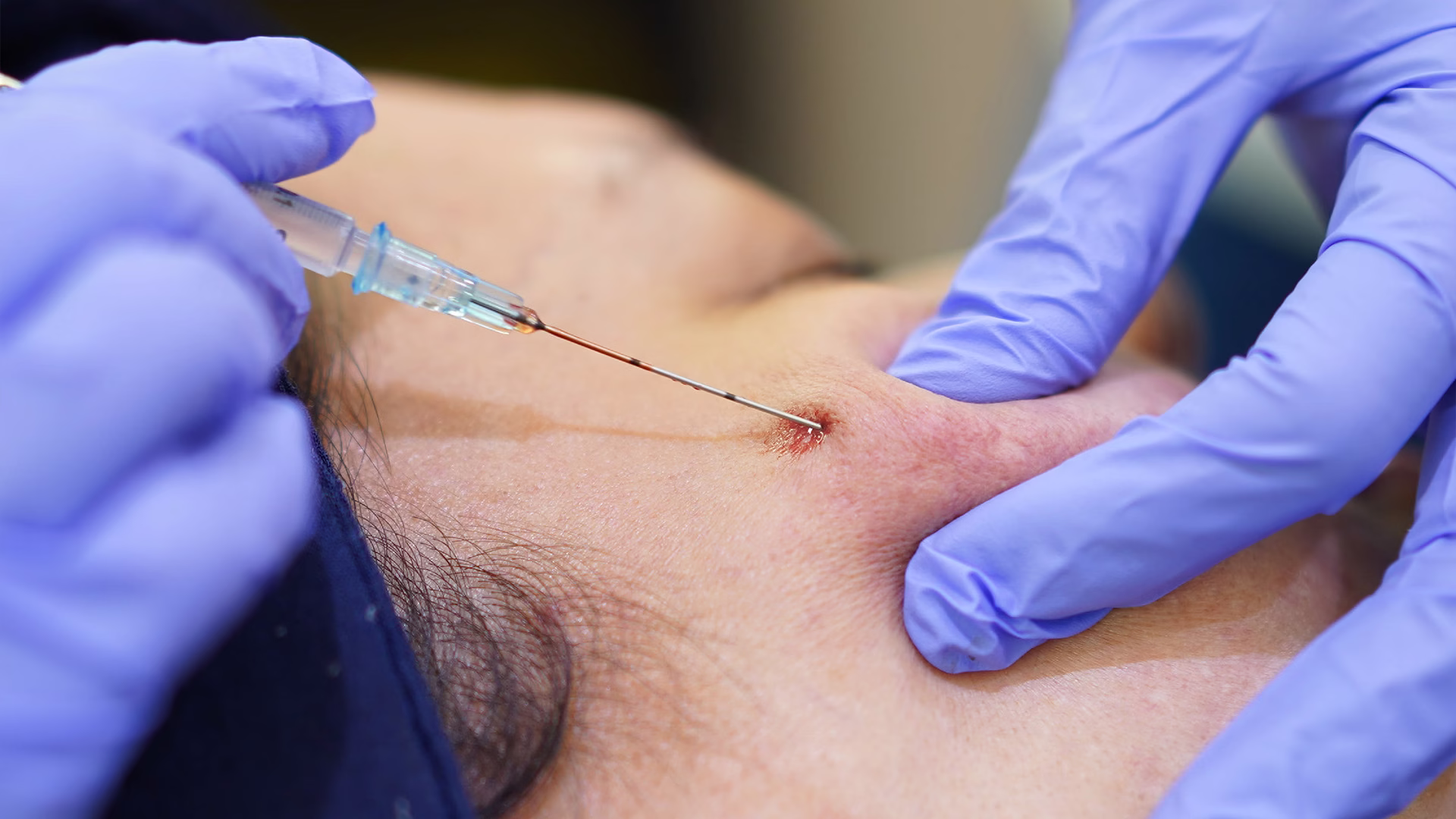 Subcision Treatment Sozo Skin Clinic