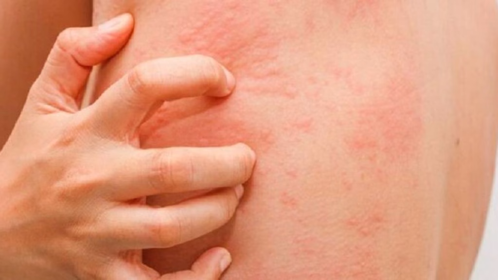 7 Cara Ampuh Menghilangkan Biduran agar Gatal Tidak Muncul Lagi