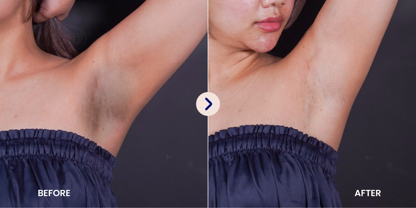 Before After IPL Underarm Hair Removal