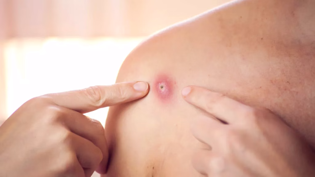 Cara Mengobati Bisul Agar Cepat Kempes Tanpa Dipencet, Ini Panduannya