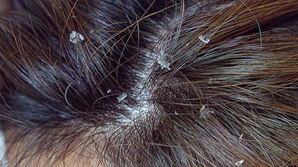 Cara Mengatasi Kulit Kepala Kering & Mengelupas dengan Scalp Treatment